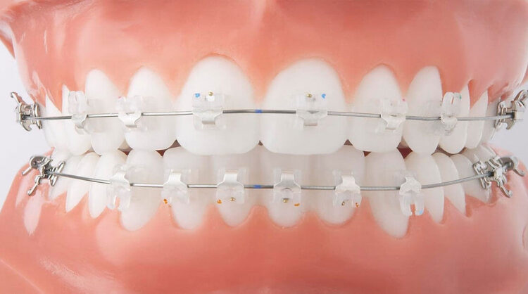 Các bước trong quy trình niềng răng bằng mắc cài sứ hiện nay