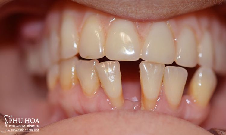 1. Nguyên nhân gây thưa răng hàm dưới 1