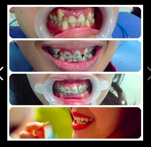 Giai đoạn niềng răng bằng phương pháp mắc cài mất bao lâu? 1