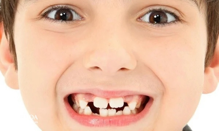 2. Răng mọc thưa ở trẻ em có nên điều trị sớm? 1