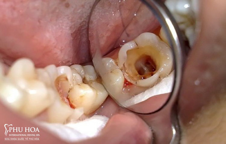 Chữa trị sâu răng cho người lớn tốn nhiều chi phí hơn 1