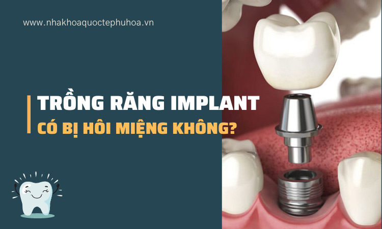 trong-rang-implant-co-bi-hoi-mieng-khong