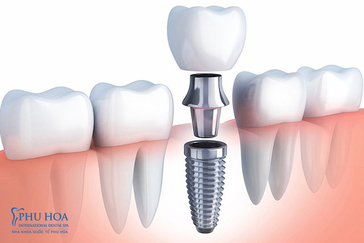 1. Có trồng răng khi còn chân răng được không?Răng gồm ba phần là men răng, ngà răng và tuỷ răng. Men răng là ph� 7