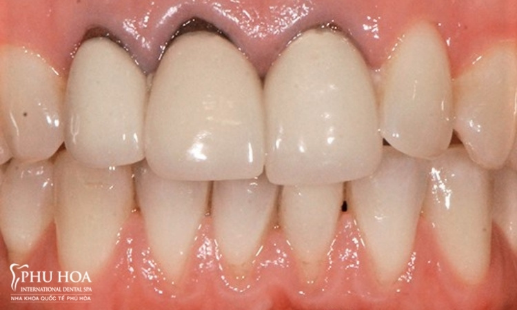 1.2. Kỹ thuật phục hình răng không chính xác 1