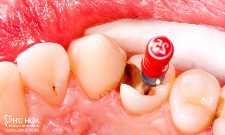 1.Răng đã lấy tủy khác gì răng thường? 1