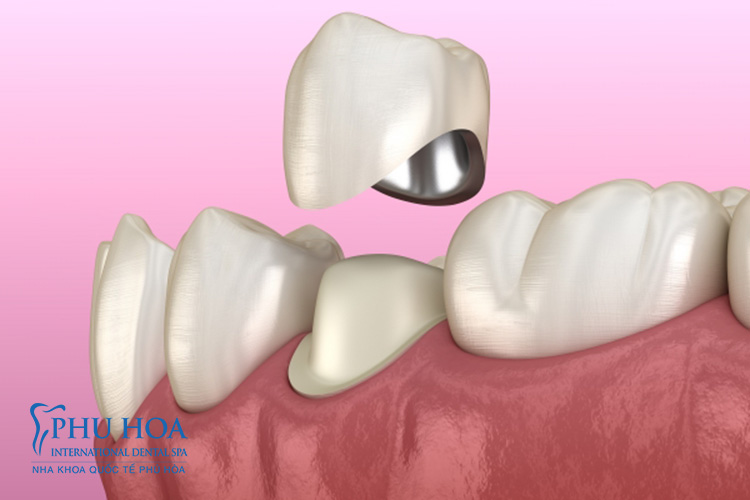 1. Có trồng răng khi còn chân răng được không?Răng gồm ba phần là men răng, ngà răng và tuỷ răng. Men răng là ph� 3
