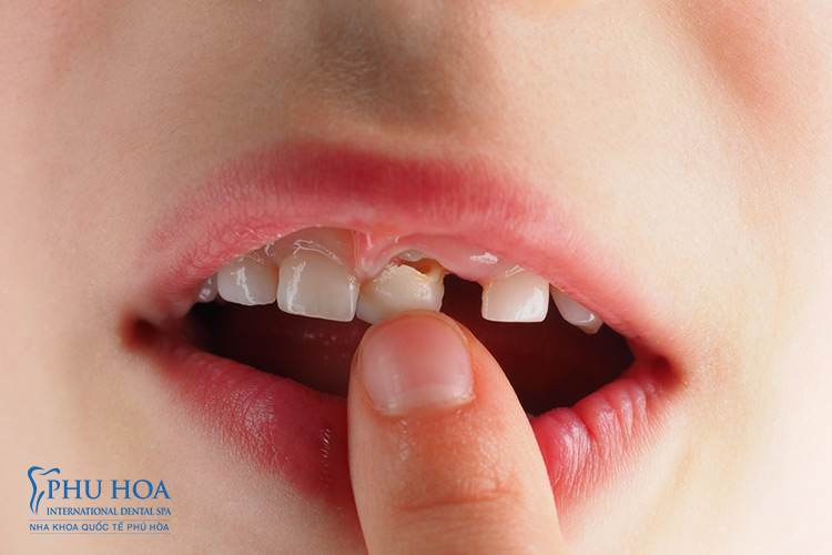 1. Có trồng răng khi còn chân răng được không?Răng gồm ba phần là men răng, ngà răng và tuỷ răng. Men răng là ph� 2