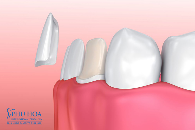 1. Có trồng răng khi còn chân răng được không?Răng gồm ba phần là men răng, ngà răng và tuỷ răng. Men răng là ph� 5