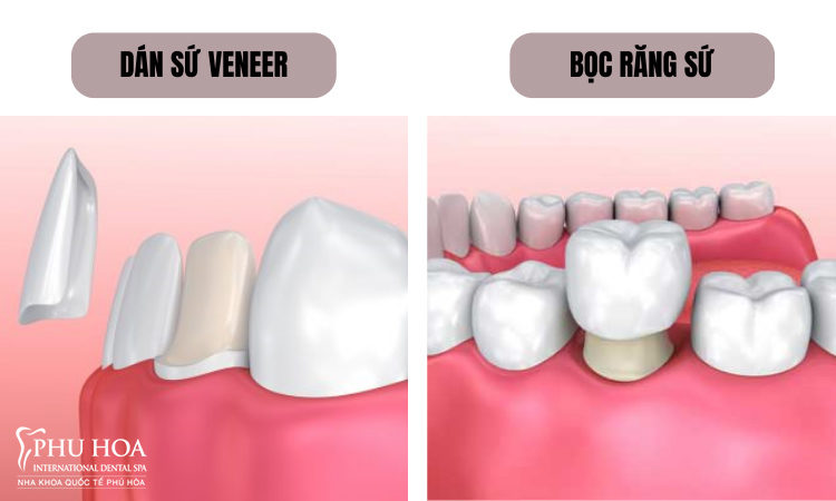 1. So sánh bọc răng sứ và dán sứ veneer 1