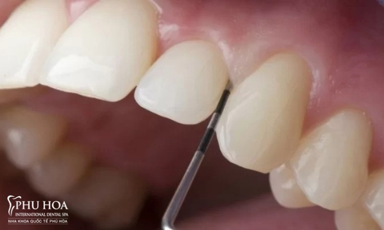 1. Trường hợp dán răng sứ cần mài răng 1