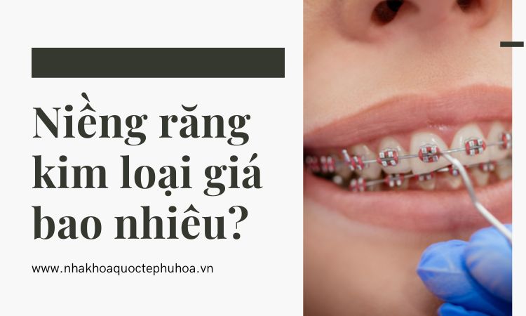 Niềng răng kim loại giá bao nhiêu? Có nên chọn mức giá rẻ? 1