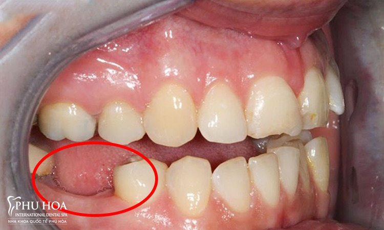 Ngăn ngừa bệnh lý răng miệng 1