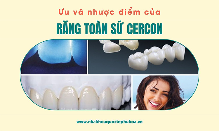 Ưu và nhược điểm của răng sứ Cercon 1