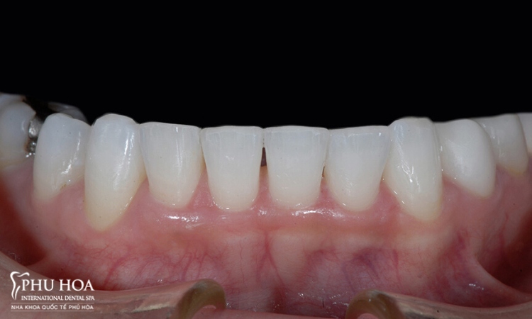 2.1. Vùng răng cửa hàm dưới 1