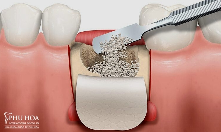 2. Quy trình trồng răng implant khi mất răng lâu năm 4