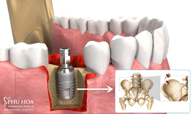 2. Quy trình trồng răng implant khi mất răng lâu năm 5