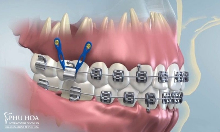 2. Quy trình trồng răng implant khi mất răng lâu năm 2