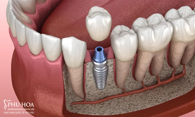 3.3. Trồng răng implant 1