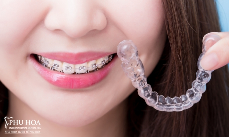 3.1. Các loại niềng răng có thể sử dụng sau khi bọc sứ 1