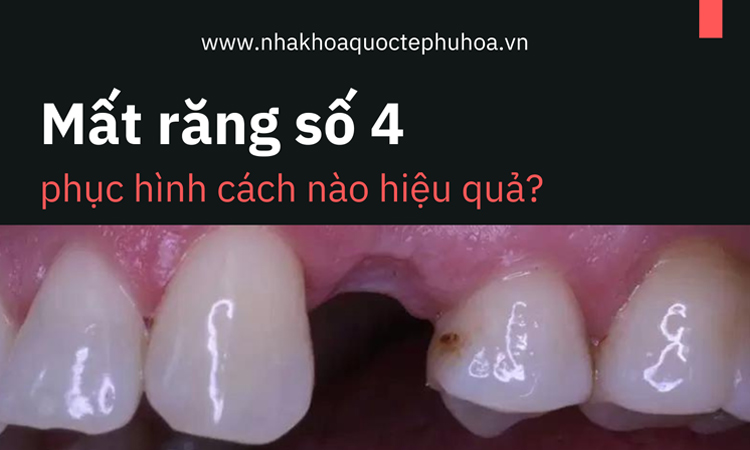 Mất răng số 4 có nguy hiểm không, phục hình bằng cách nào? 1
