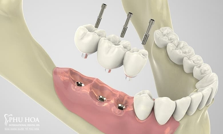2. Quy trình trồng răng implant khi mất răng lâu năm 6