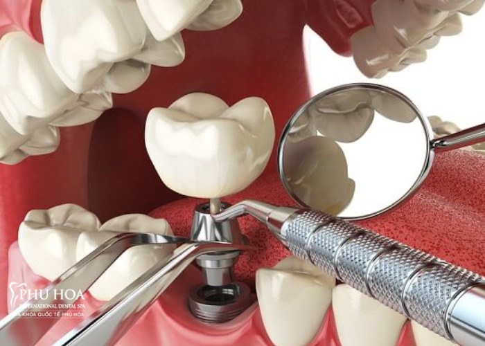 1. Trồng răng implant có niềng được răng không? 1