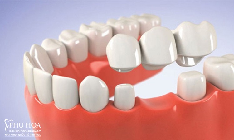 1. Trồng răng implant có niềng được răng không? 2