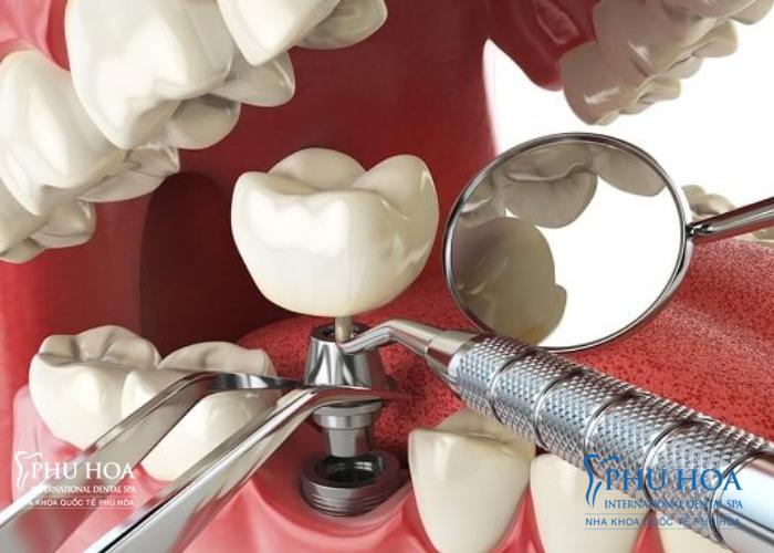 Trụ implant sẽ được lắp đặt trước lắp mão răng