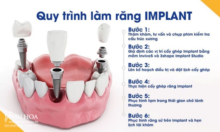 2. Niềng răng sau khi trồng implant được thực hiện thế nào? 1