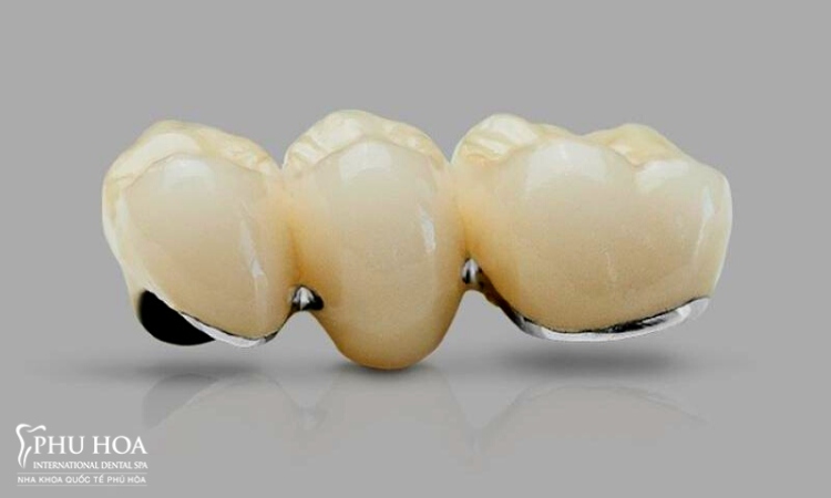 1. Những yếu tố ảnh hưởng tới độ bền của răng sứTuổi thọ của răng sứ phụ thuộc vào nhiều yếu tố k 7
