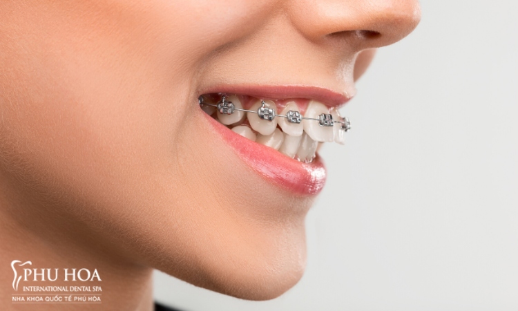 2.Răng đã lấy tủy trưởng hợp nào có thể niềng được? 1