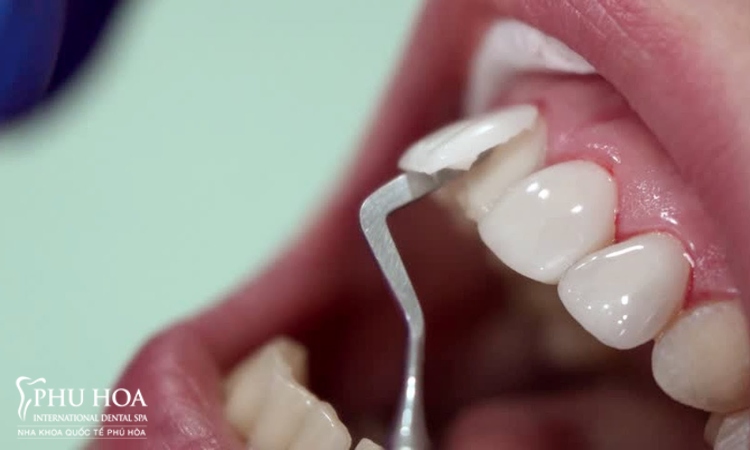 1. Nguyên nhân do đâu mà bọc răng sứ bị lệch khớp cắn?Bọc răng sứ là phương pháp khắc phục hình dạng, kíc 6