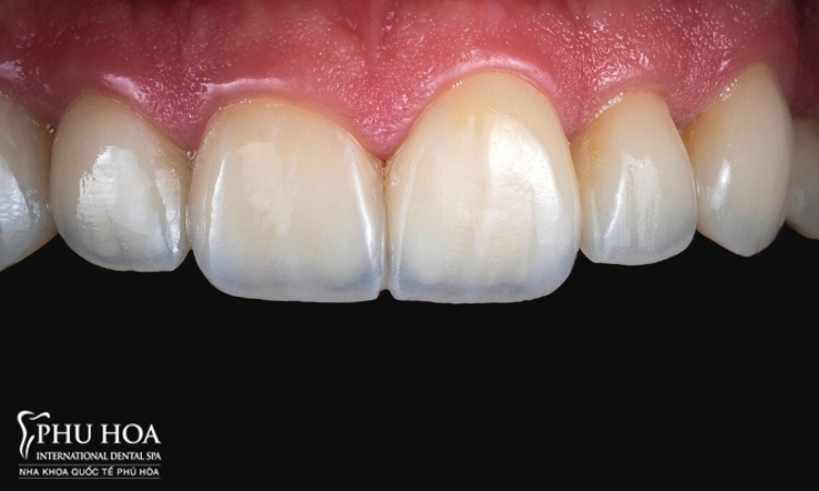 3. Nên bọc răng sứ 2 răng cửa bị hô bằng loại nào? 1