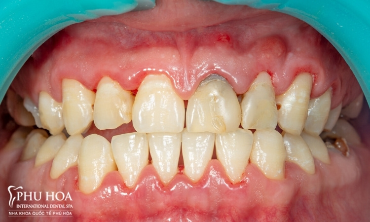 1. Những yếu tố ảnh hưởng tới độ bền của răng sứTuổi thọ của răng sứ phụ thuộc vào nhiều yếu tố k 1