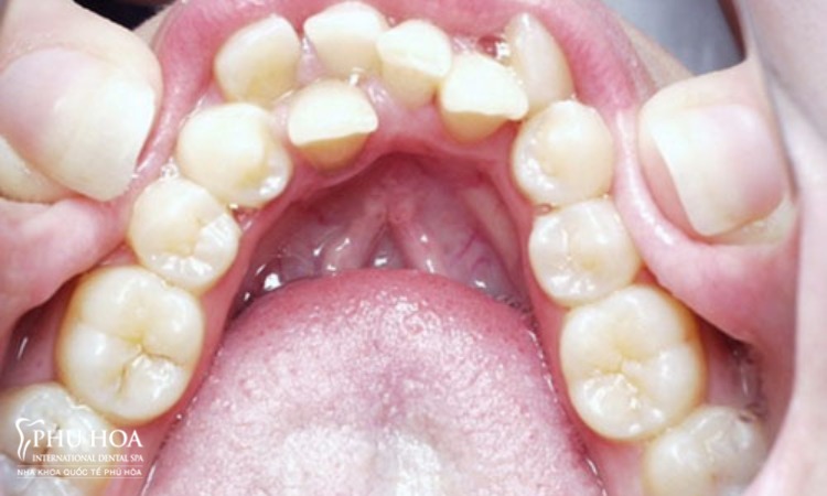 Tại sao một số người lại mọc 36 cái răng? 1