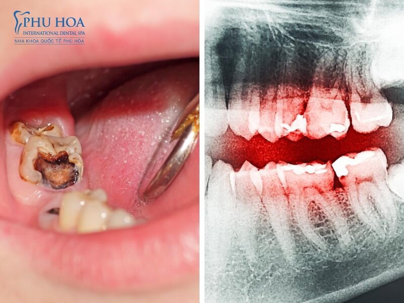 Chẩn đoán bệnh sâu răng như thế nào