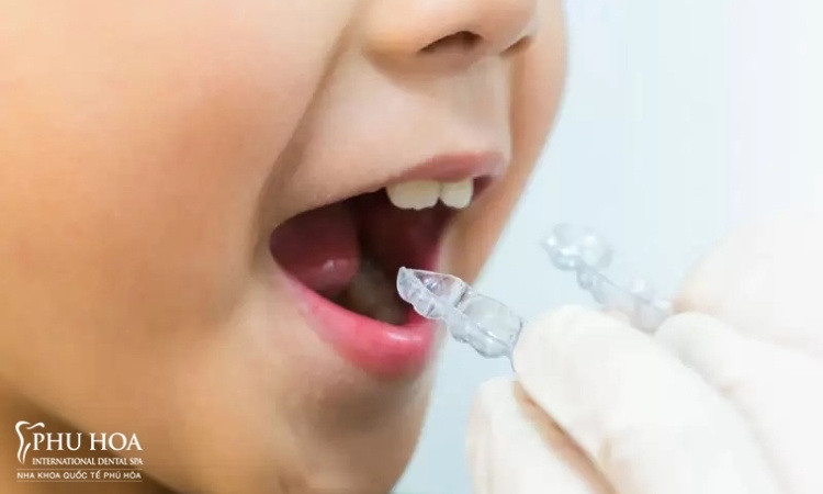 Khả năng tháo niềng linh hoạt