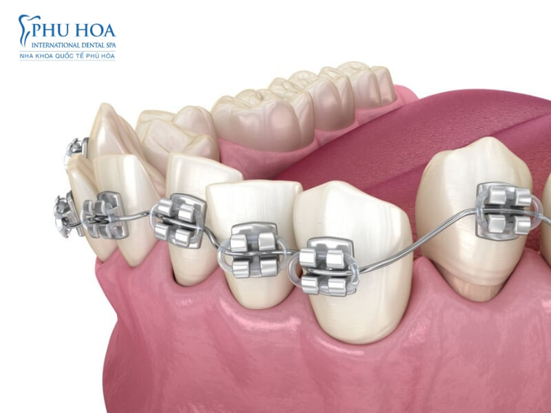 Niềng răng mắc cài 3M UGLS với công nghệ tiên tiến nhất mang tới chất lượng vượt trội.