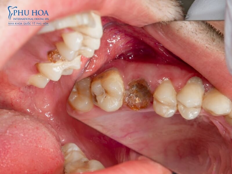 Răng sâu nhiễm trùng nướu và xương răng 