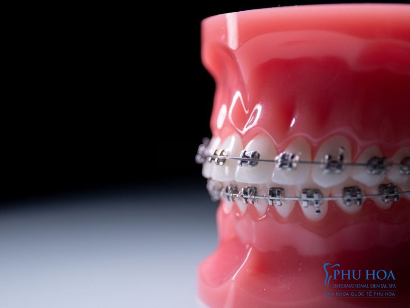 Thời gian của niềng răng mắc cài sẽ kéo dài từ 18 đến 36 tháng tùy trường hợp