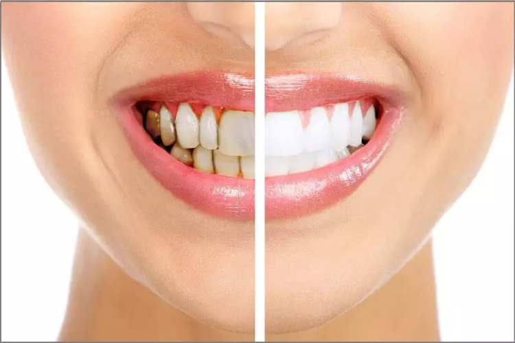 Bọc sứ thẩm mỹ giúp khắc phục được được những những khuyết điểm của hàm răng