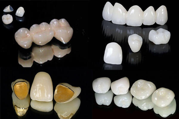 Có nhiều loại răng sứ khác nhau, mỗi loại sẽ phù hợp với từng tình trạng răng miệng khác nhau