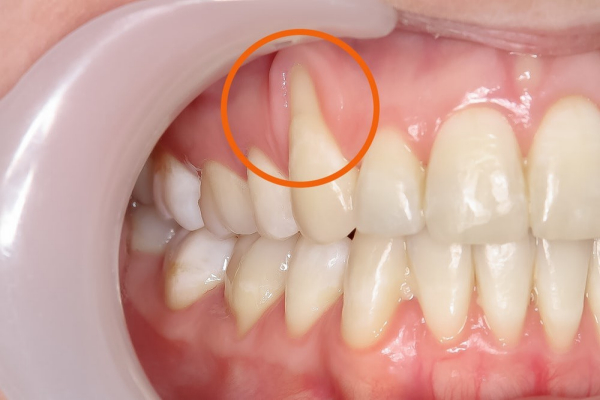 Bọc răng sứ có thể gây tụt lợi nếu lựa chọn chất liệu không phù hợp