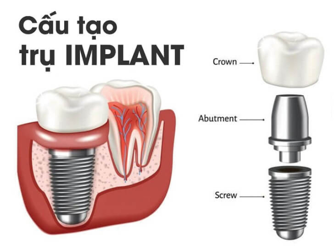 Chi tiết các bộ phận cấu tạo răng Implant chi tiết