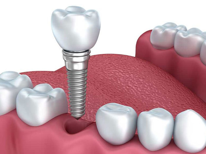 Tìm hiểu thế nào là phương pháp trồng răng Implant? 
