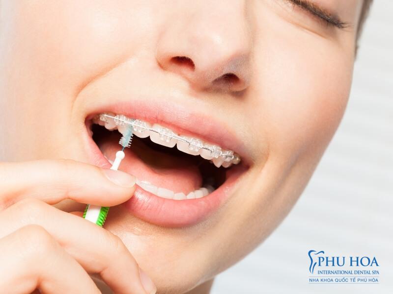 Niềng răng mắc cài pha lê đem lại tính thẩm mỹ, an toàn và dễ dàng vệ sinh răng miệng