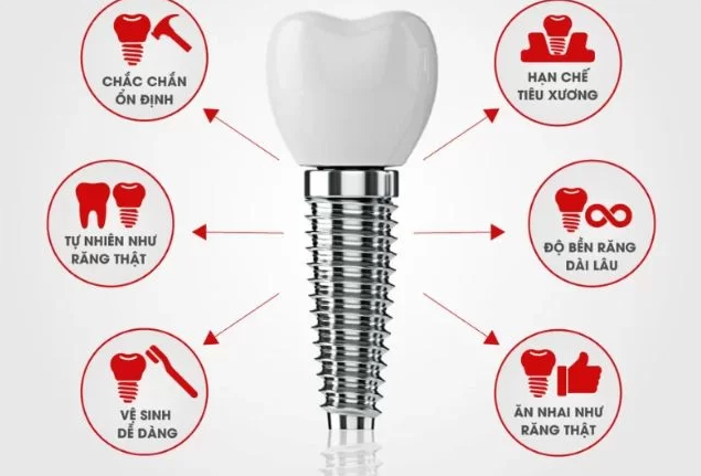 Trụ Implant Dentium Hàn Quốc có nhiều ưu điểm nổi trội