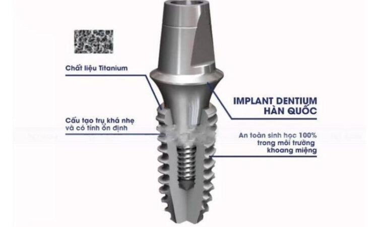 Trụ Implant Hàn Quốc có độ an toàn sinh học 100% trong khoang miệng
