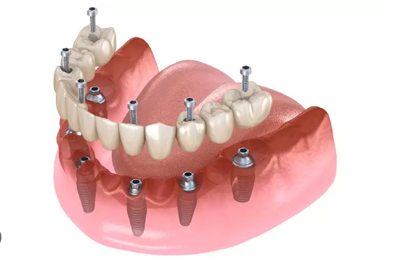 Phục hình bắt vít trên implant - phương pháp trồng răng đơn lẻ