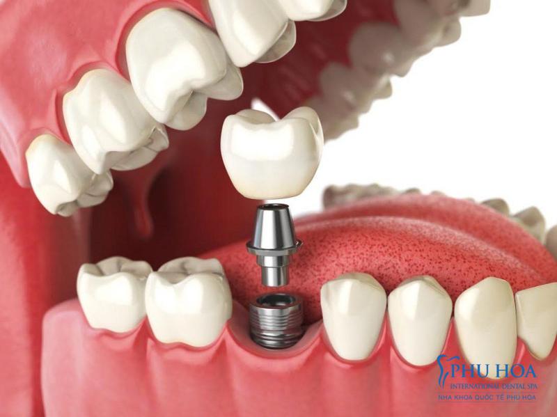 Tìm hiểu kỹ thuật làm răng Implant gắn xi